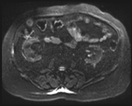 Adrenal cortical carcinoma (Radiopaedia 64017-72770 Axial DWI 72).jpg