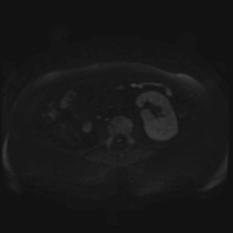 Adrenal cortical carcinoma (Radiopaedia 70906-81116 Axial DWI 51).jpg