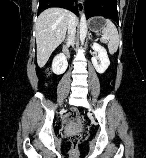 Adrenal cortical carcinoma (Radiopaedia 84882-100379 Coronal C+ portal venous phase 39).jpg