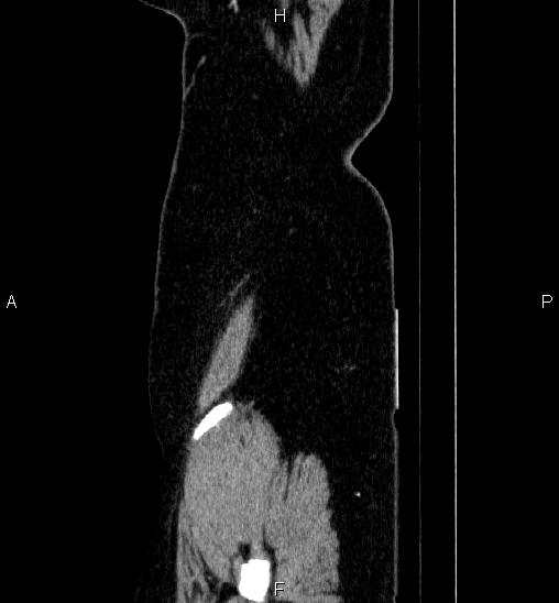 Adrenal cortical carcinoma (Radiopaedia 84882-100379 Sagittal C+ portal venous phase 88).jpg