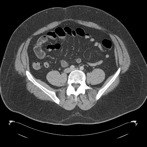 File:Adrenal cyst (Radiopaedia 45625-49776 Axial C+ portal venous phase 64).png