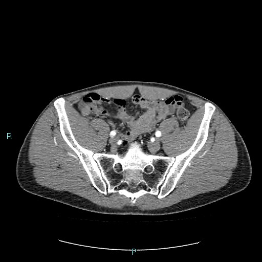 Adrenal cystic lymphangioma (Radiopaedia 83161-97534 Axial C+ arterial phase 76).jpg