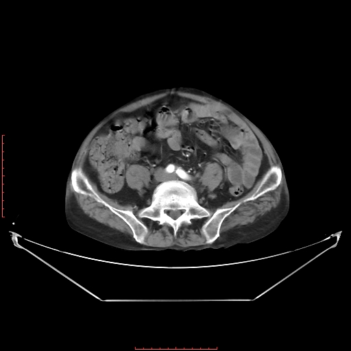 Adrenal hemangioma (Radiopaedia 68923-78668 Axial C+ arterial phase 51).jpg