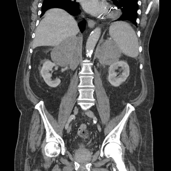 Adrenal lymphoma (Radiopaedia 84145-99415 Coronal C+ portal venous phase 53).jpg