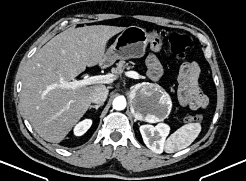 Adrenal metastases (Radiopaedia 73082-83791 Axial C+ arterial phase 48).jpg