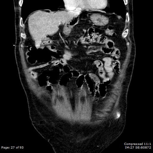 Adrenal metastasis (Radiopaedia 78425-91079 Sagittal C+ portal venous phase 14).jpg