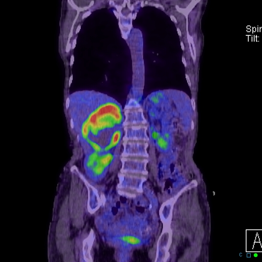 File:Adrenal metastasis from small cell lung cancer (Radiopaedia 19133-19109 Coronal 20).jpg
