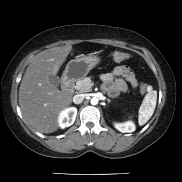 Adrenal myelolipoma (Radiopaedia 43401-46759 Axial C+ arterial phase 34).jpg