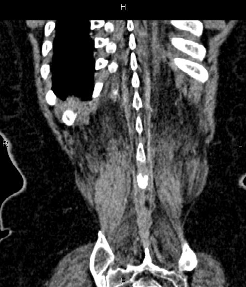 Adrenal myelolipoma (Radiopaedia 82742-96986 Coronal renal cortical phase 68).jpg
