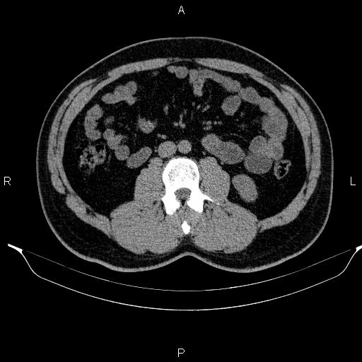 Adrenal myelolipoma (Radiopaedia 84321-99619 Axial non-contrast 59).jpg