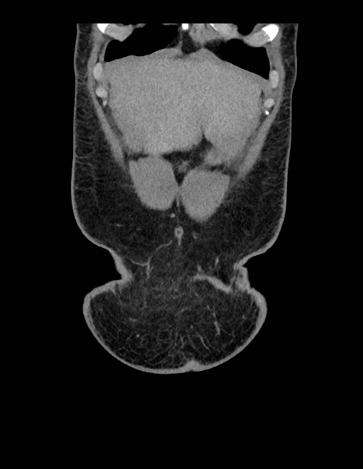 Adrenal myelolipoma - bilateral (Radiopaedia 74805-85810 Coronal C+ portal venous phase 239).jpg