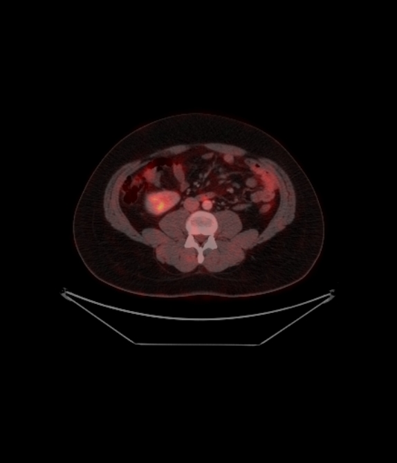 Adrenocortical carcinoma (Radiopaedia 80134-93440 ِAxial 196).jpg