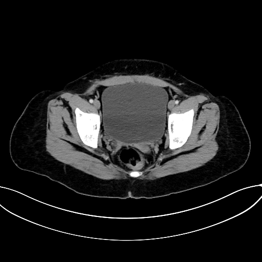 Adrenocortical carcinoma (Radiopaedia 87281-103569 Axial C+ portal venous phase 79).jpg