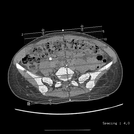 File:Adult polycystic kidney disease (Radiopaedia 48845-53876 Coronal renal excretory phase 1).jpg