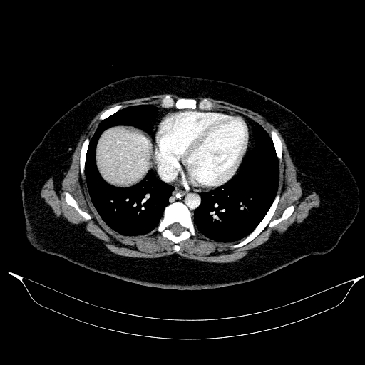File:Afferent loop syndrome - secondary to incarcerated trocar site hernia (Radiopaedia 82959-97305 Axial C+ portal venous phase 15).jpg
