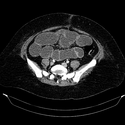 File:Afferent loop syndrome - secondary to incarcerated trocar site hernia (Radiopaedia 82959-97305 Axial C+ portal venous phase 167).jpg