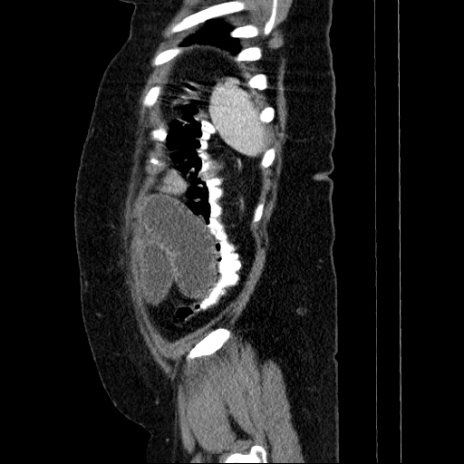 Afferent loop syndrome - secondary to incarcerated trocar site hernia (Radiopaedia 82959-97305 Sagittal C+ portal venous phase 18).jpg