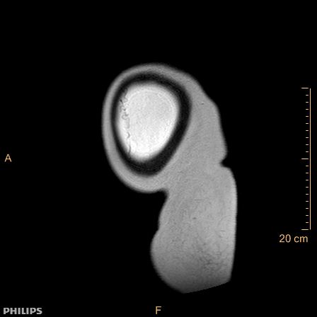 Aggressive angiomyxoma (Radiopaedia 73343-84093 Sagittal T2 1).jpg
