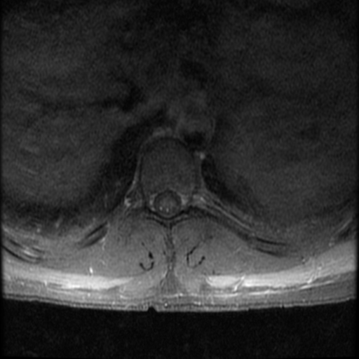 File:Aggressive vertebral hemangioma (Radiopaedia 39937-42404 Axial T1 C+ fat sat 12).png