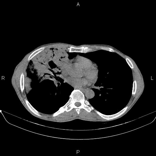 Air bronchogram in pneumonia (Radiopaedia 85719-101512 Axial non-contrast 38).jpg