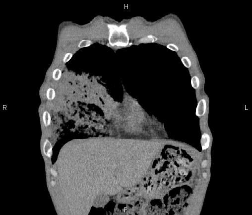 Air bronchogram in pneumonia (Radiopaedia 85719-101512 Coronal non-contrast 9).jpg