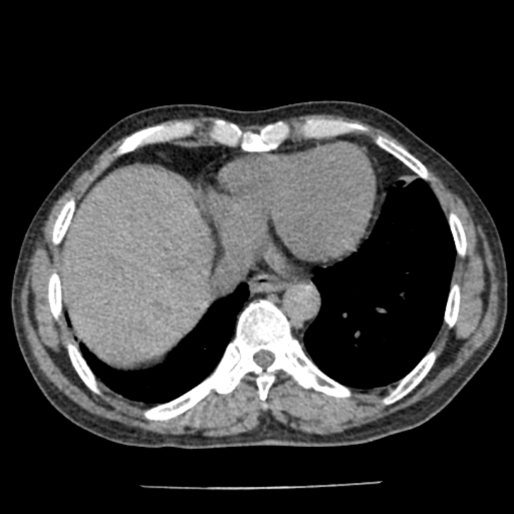 Airway foreign body in adult (Radiopaedia 85907-101779 Axial liver window 143).jpg