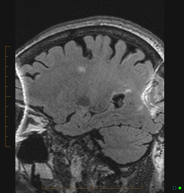 Aliasing artifact causing a spurious cerebellar lesion (Radiopaedia 48783-53810 Sagittal FLAIR 5).jpg