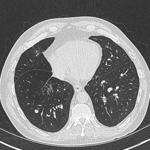 File:Allergic bronchopulmonary aspergillosis (Radiopaedia 44760-48571 Axial lung window 47).png