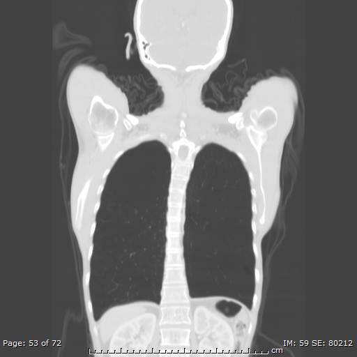 Alpha-1-antitrypsin deficiency (Radiopaedia 50561-55987 Coronal lung window 51).jpg