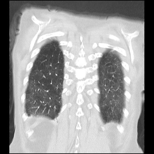 File:Alpha-1-antitrypsin deficiency (Radiopaedia 64893-73840 Coronal lung window 32).jpg