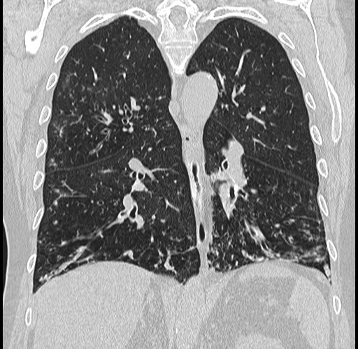 Alpha-1-antitrypsin deficiency (Radiopaedia 72058-82557 Coronal lung window 55).jpg