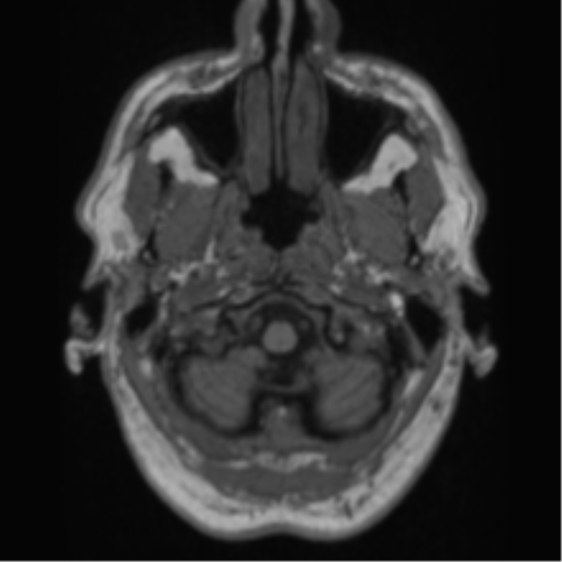 Alzheimer's disease- with Gerstmann syndrome and dressing apraxia (Radiopaedia 54882-61150 Axial T1 5).png