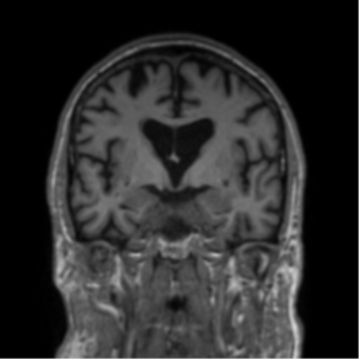 Alzheimer's disease- with Gerstmann syndrome and dressing apraxia (Radiopaedia 54882-61150 Coronal T1 51).png