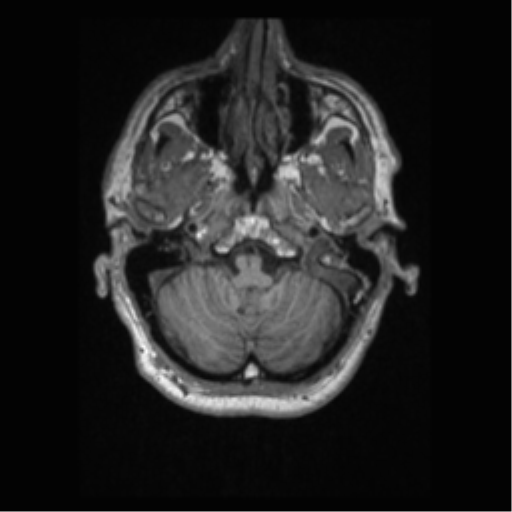 Alzheimer disease - probable (Radiopaedia 35334-36837 Axial T1 16).png