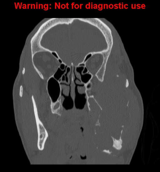 File:Ameloblastoma (Radiopaedia 13276-13280 Coronal non-contrast 13).jpg