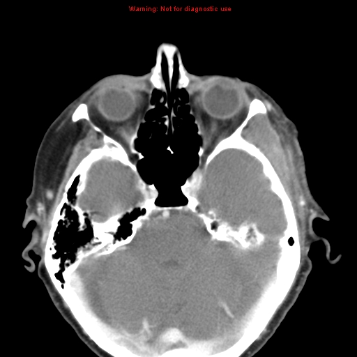 Ameloblastoma (Radiopaedia 27437-27631 A 1).jpg