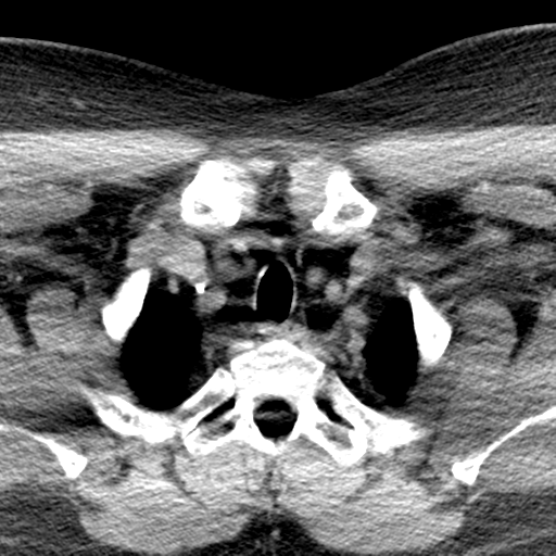 Ameloblastoma (Radiopaedia 38520-40623 Axial non-contrast 75).png