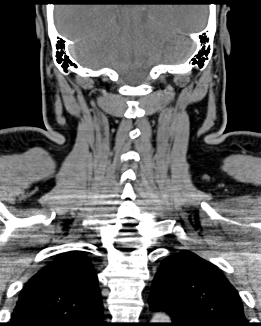 Ameloblastoma (Radiopaedia 38520-40623 Coronal non-contrast 56).png