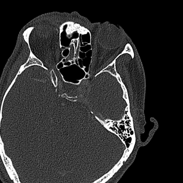 Ameloblastoma (Radiopaedia 51921-57766 Axial bone window 177).jpg