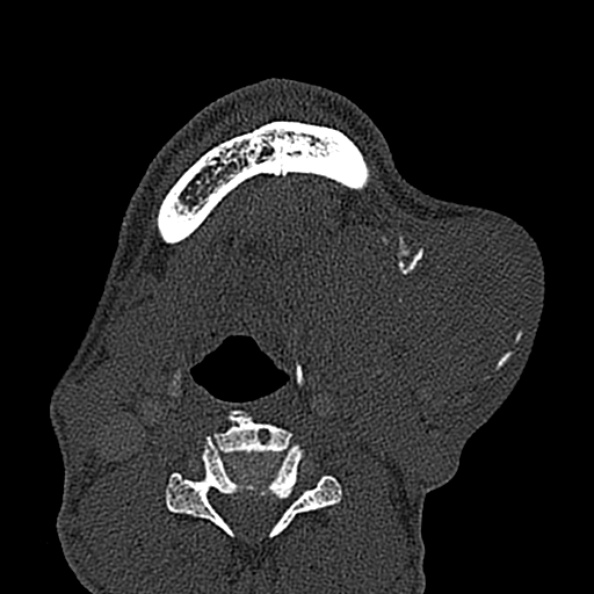 Ameloblastoma (Radiopaedia 51921-57766 Axial bone window 30).jpg