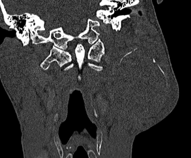 Ameloblastoma (Radiopaedia 51921-57766 Coronal bone window 208).jpg