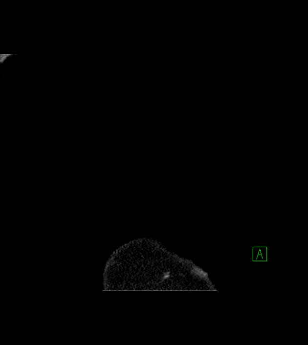 Amiodarone deposition in the liver (Radiopaedia 77587-89780 Coronal non-contrast 3).jpg