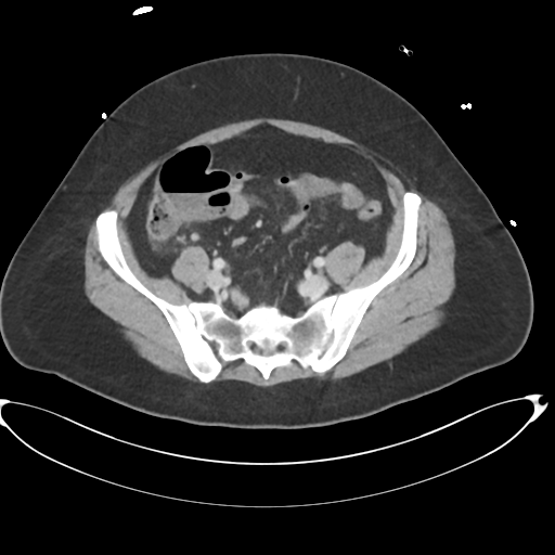 File:Amoebic liver abscess (Radiopaedia 52611-58530 A 74).png