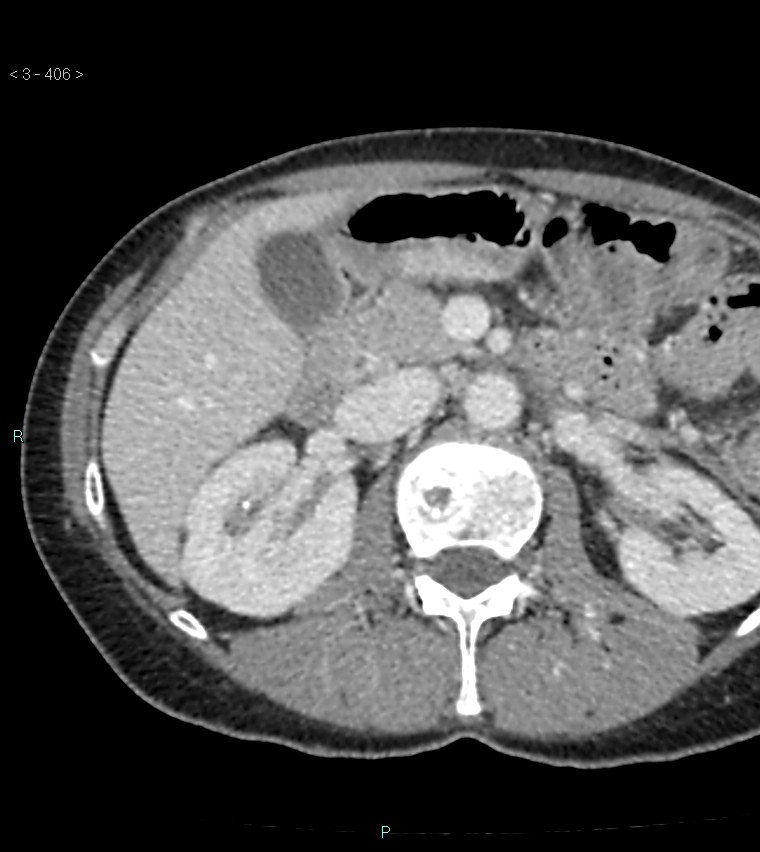 Ampulla of Vater metastasis (Radiopaedia 27820-28065 A 10).jpg
