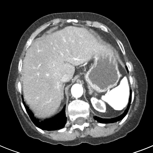 Ampullary adenocarcinoma (Radiopaedia 34013-35237 B 14).png