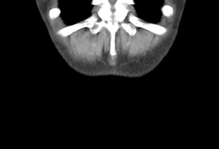 Ampullary adenocarcinoma (Radiopaedia 34013-35241 Coronal 53).png