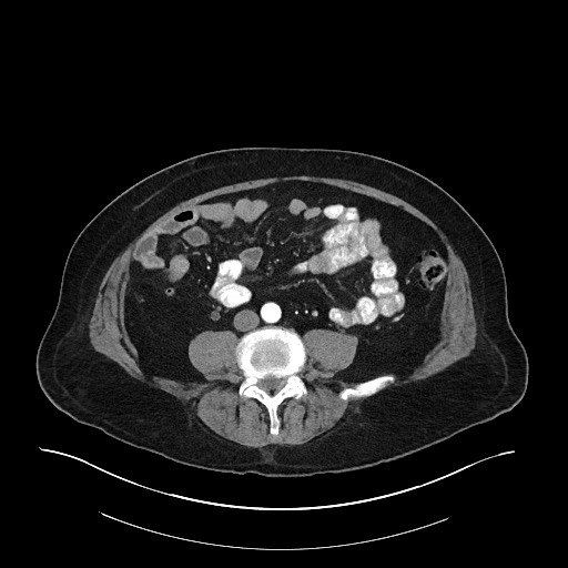 Ampullary adenocarcinoma (Radiopaedia 59373-66734 A 104).jpg