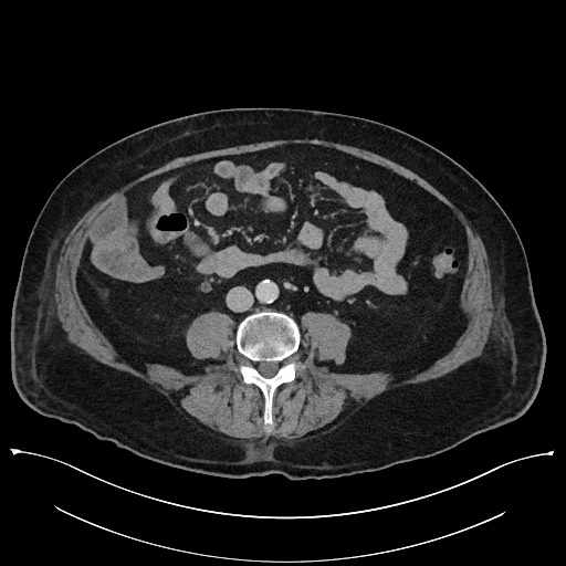 Ampullary adenocarcinoma (Radiopaedia 59373-66737 A 100).jpg
