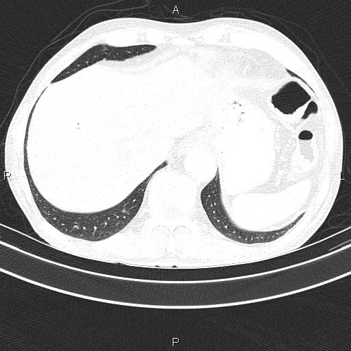 Ampullary adenocarcinoma (Radiopaedia 86093-102033 Axial lung window 49).jpg