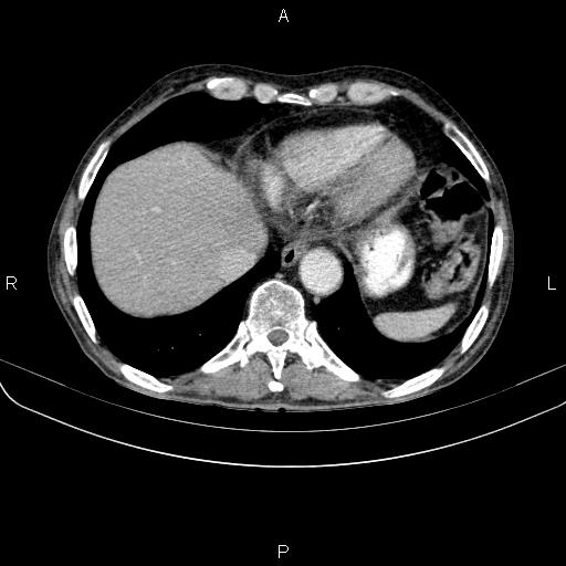 Ampullary adenocarcinoma (Radiopaedia 86093-102033 B 47).jpg